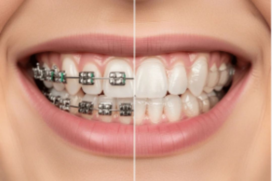 dental braces before and after real patient results in mumbai